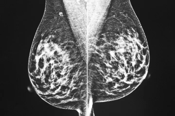 کاهش موارد ابتلا به سرطان در کانادا